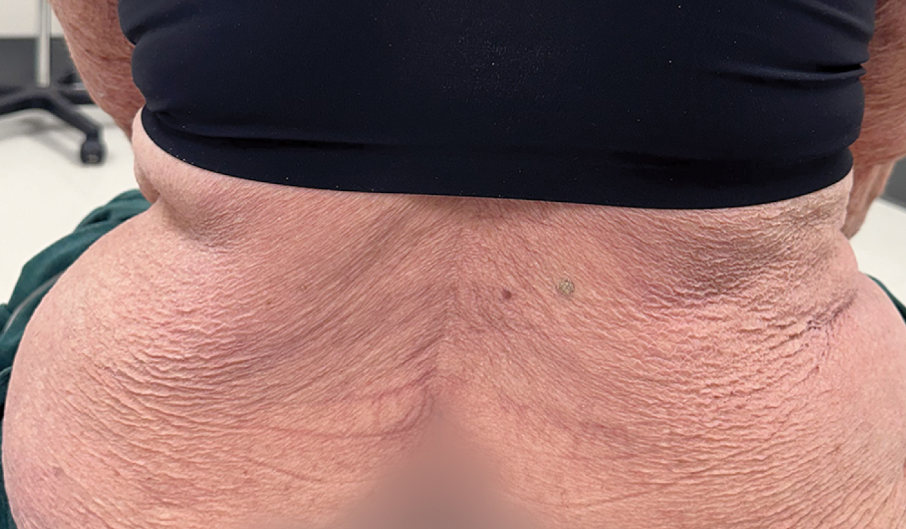 Real patient picture of the arms of a moderate to severe plaque psoriasis patient after 24 weeks of taking SOTYKTU®.