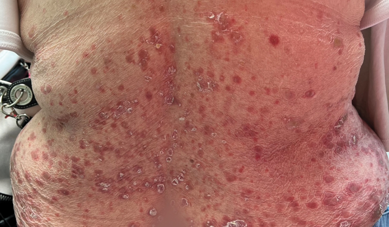 Real patient picture of moderate to severe plaque psoriasis on arms on day 0 of SOTYKTU®.